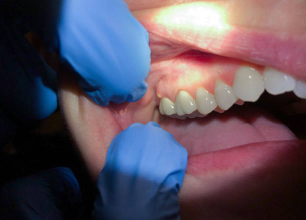 Best Emergency Broken Tooth Repair in Lincoln Park, NJ